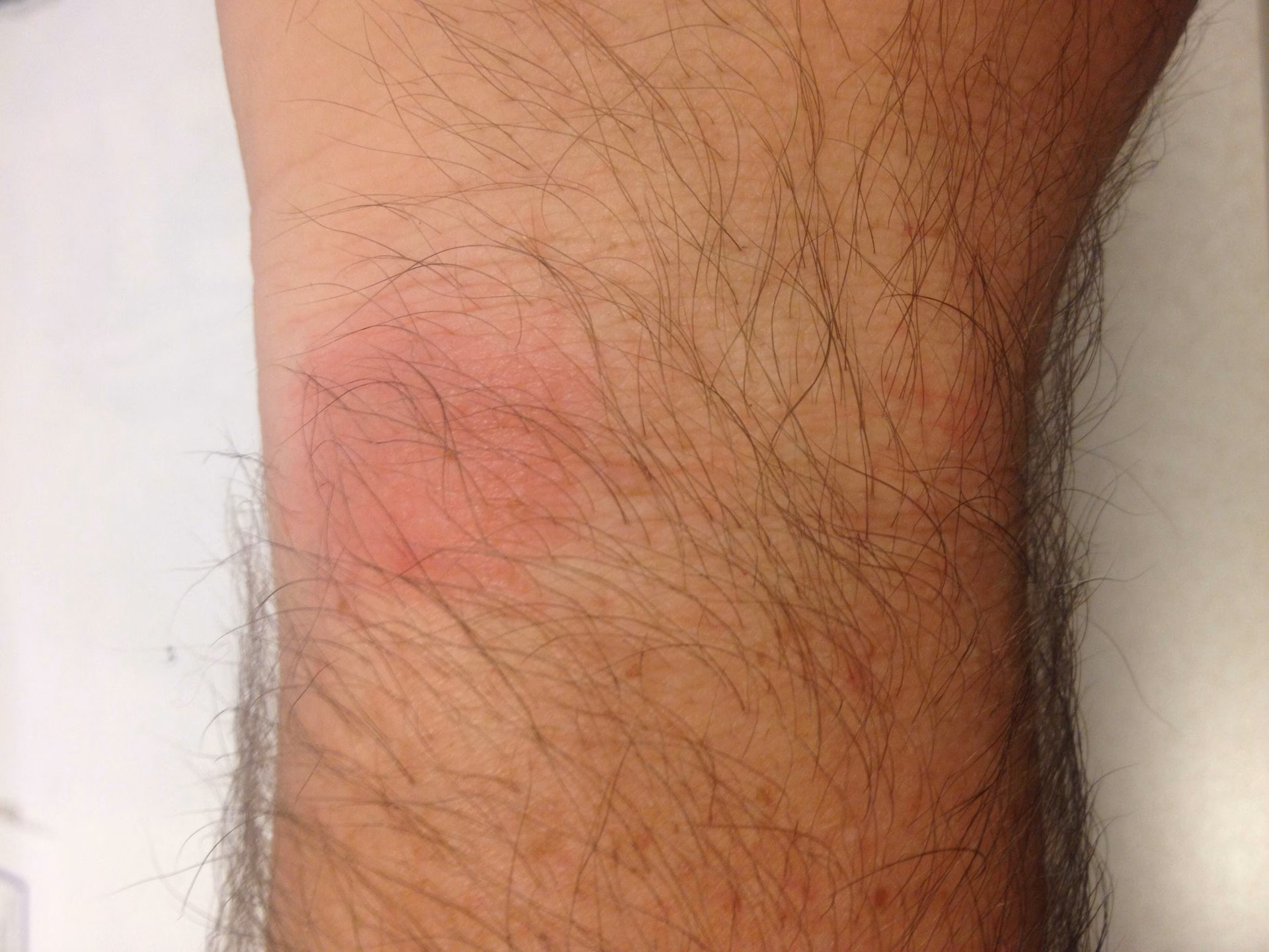 Can a Fitbit rash be a mild dermatitis?