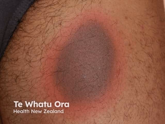 What is a fixed drug eruption?