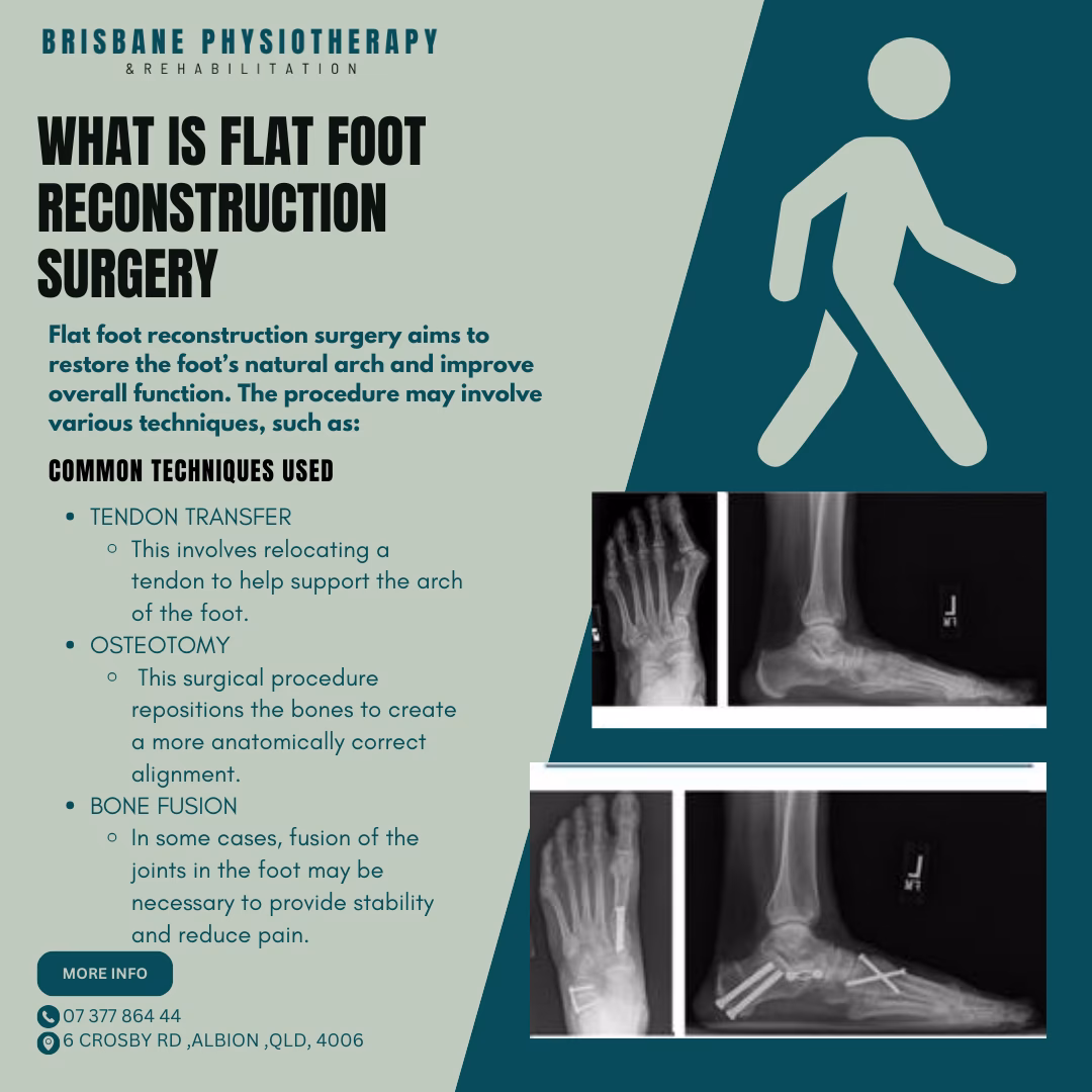 What is reconstruction surgery for flat feet?