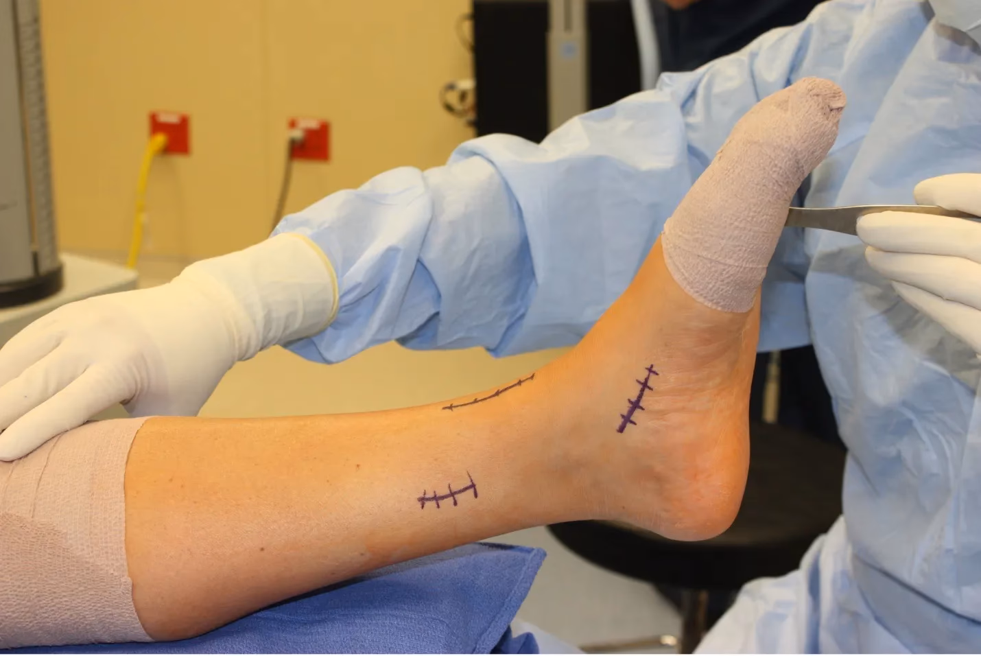Does foot drop need surgery?