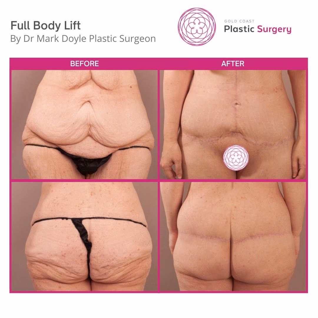 What is a total body lift?