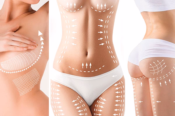 What is a body lift procedure?
