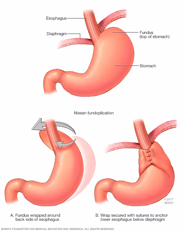 What is fundoplication & how does it work?