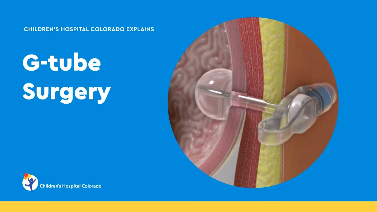 Does tube feeding modulation reduce the incidence of aspiration pneumonia?