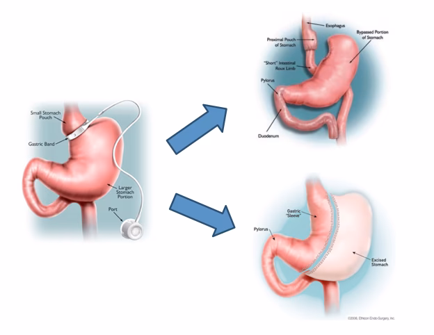 Is gastric band surgery available in the UK?