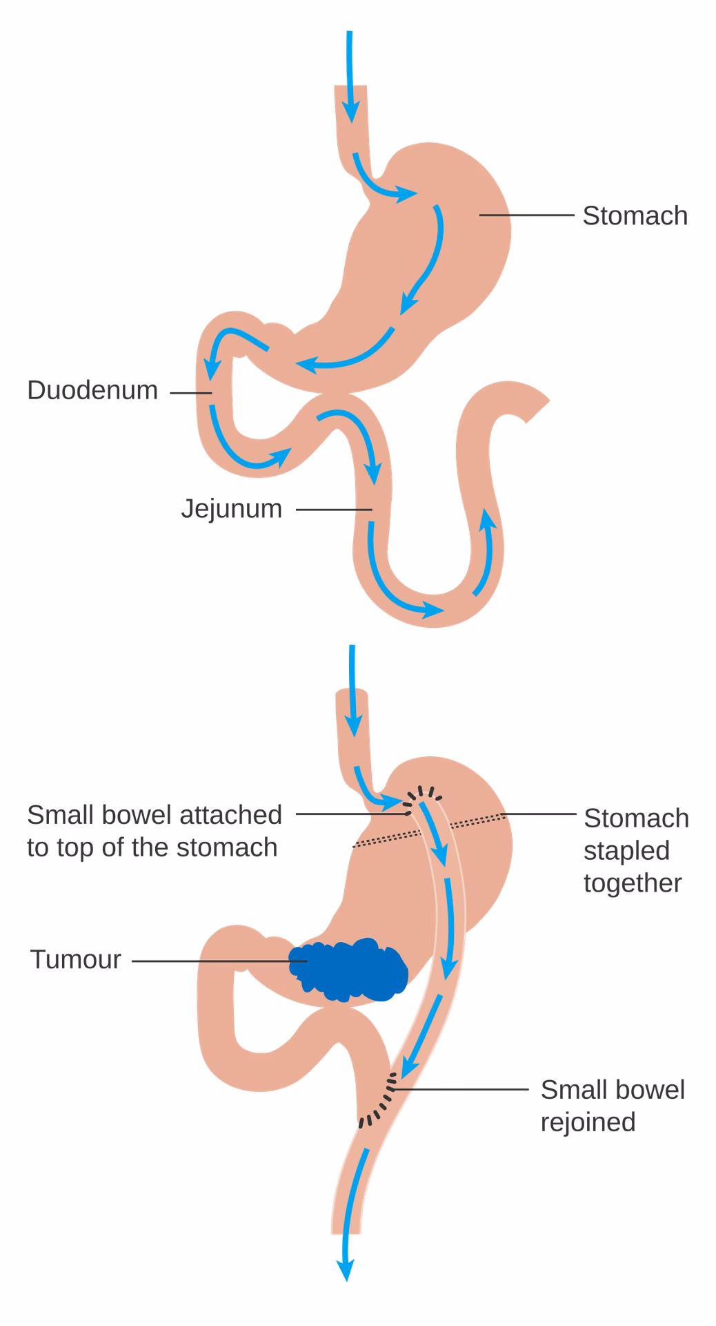 What is bariatric surgery?