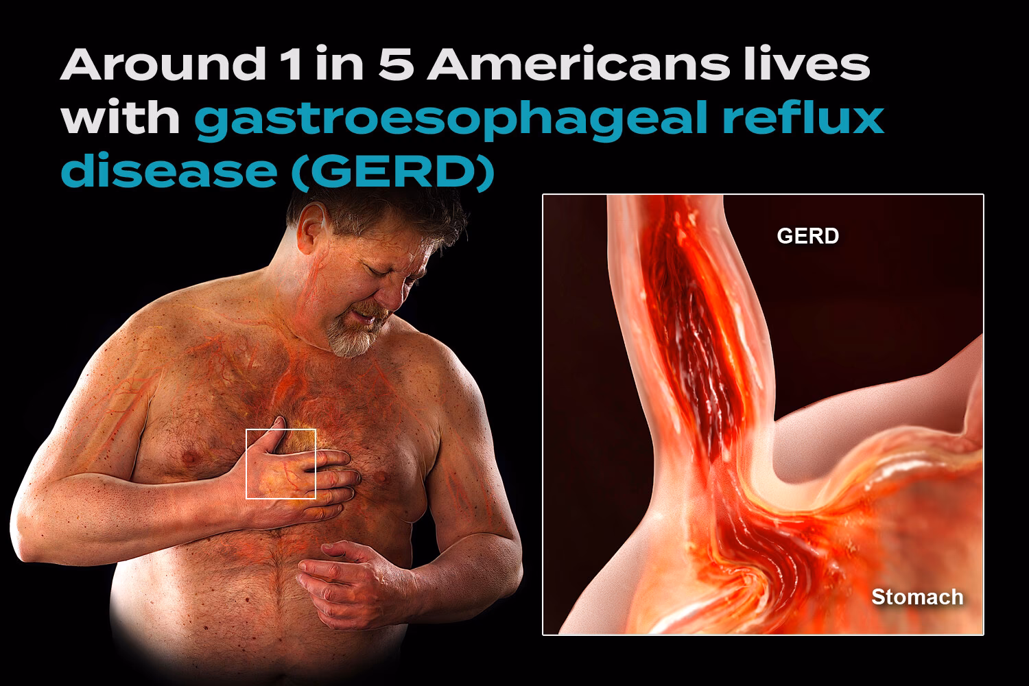 What is gastro-oesophageal reflux disease (GORD)?