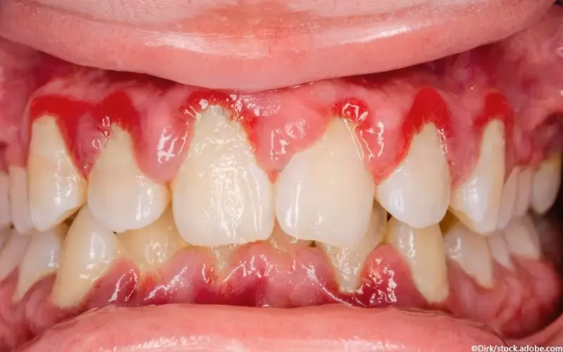 Was hilft am besten gegen Gingivitis?