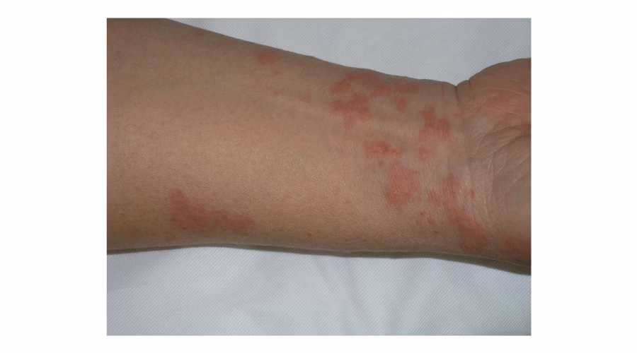 Can Ginkgo cause a rash?