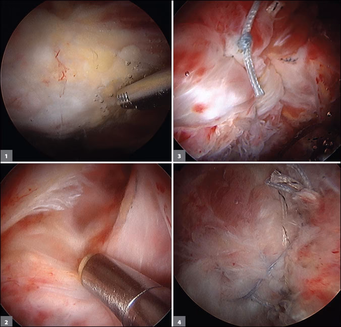 How long does it take to recover from gluteus medius & minimus surgery?