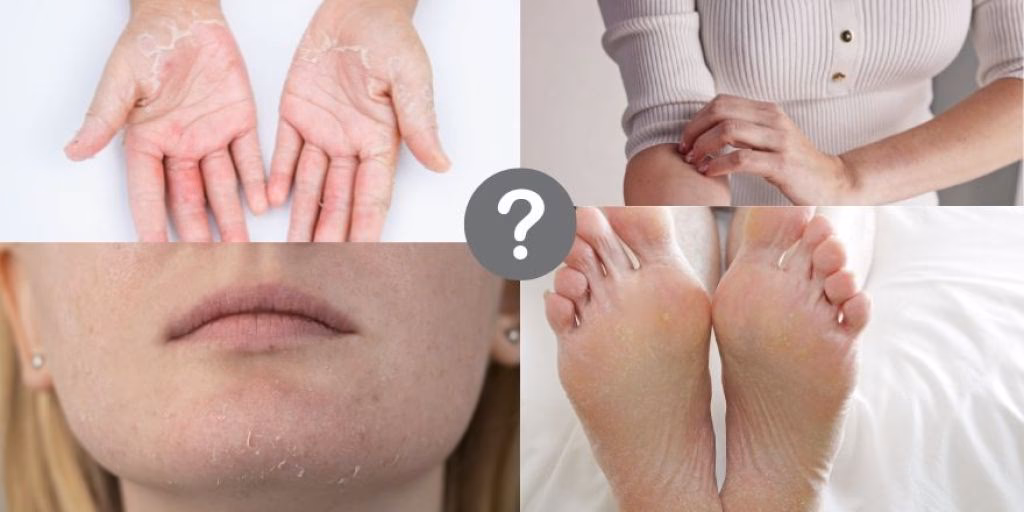 How to treat glycerin allergy?