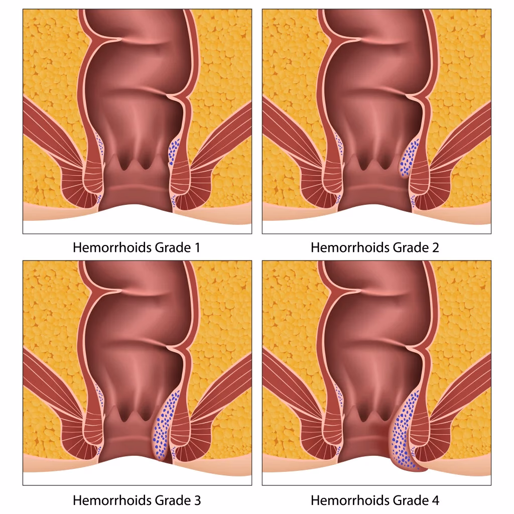 Do hemorrhoids bleed?