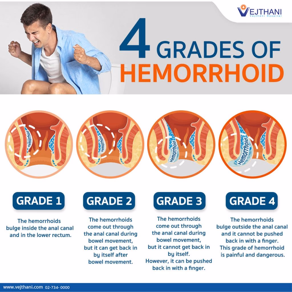 What are the symptoms of Grade 1 hemorrhoids?