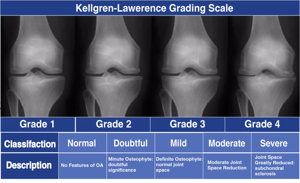 What is Stage 4 osteoarthritis?