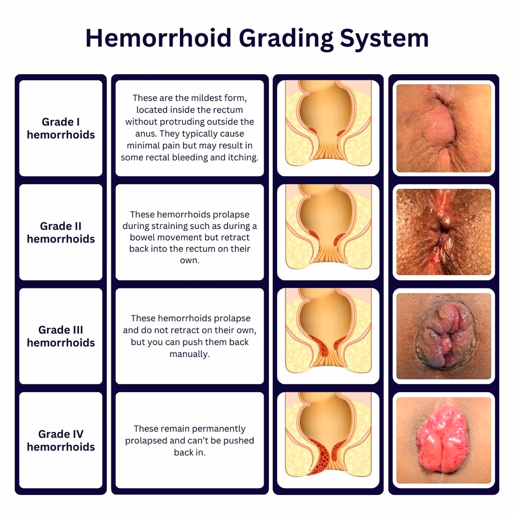 How are internal hemorrhoids graded?