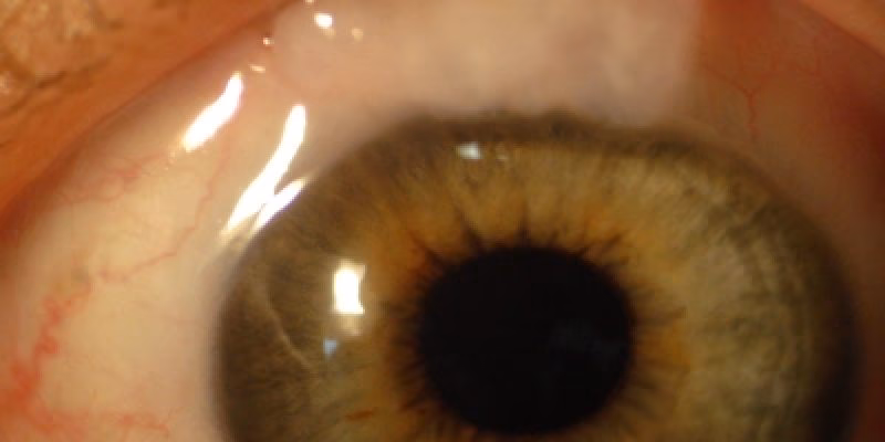 Hvad er akut grøn stær?