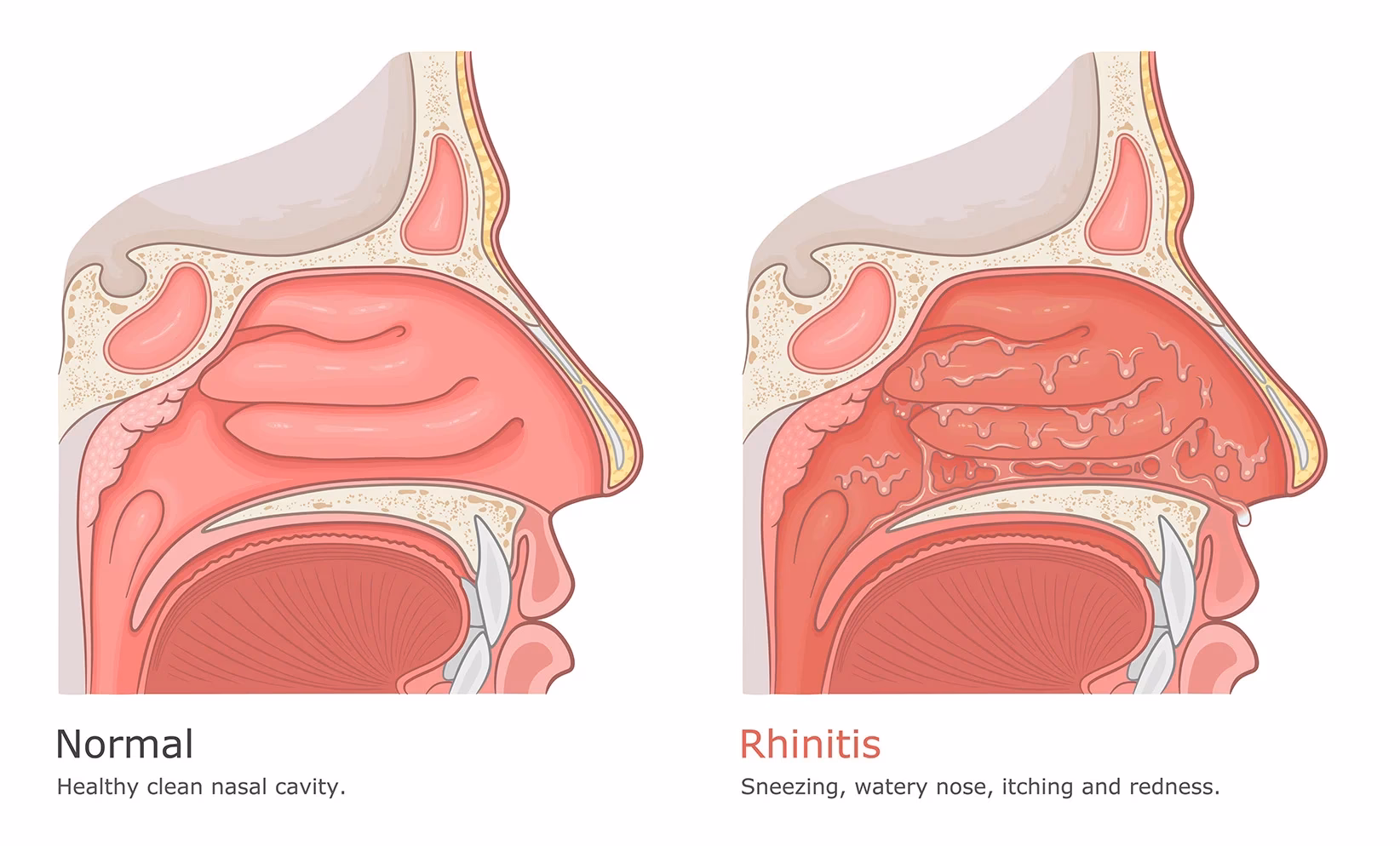 What is gustatory rhinitis?