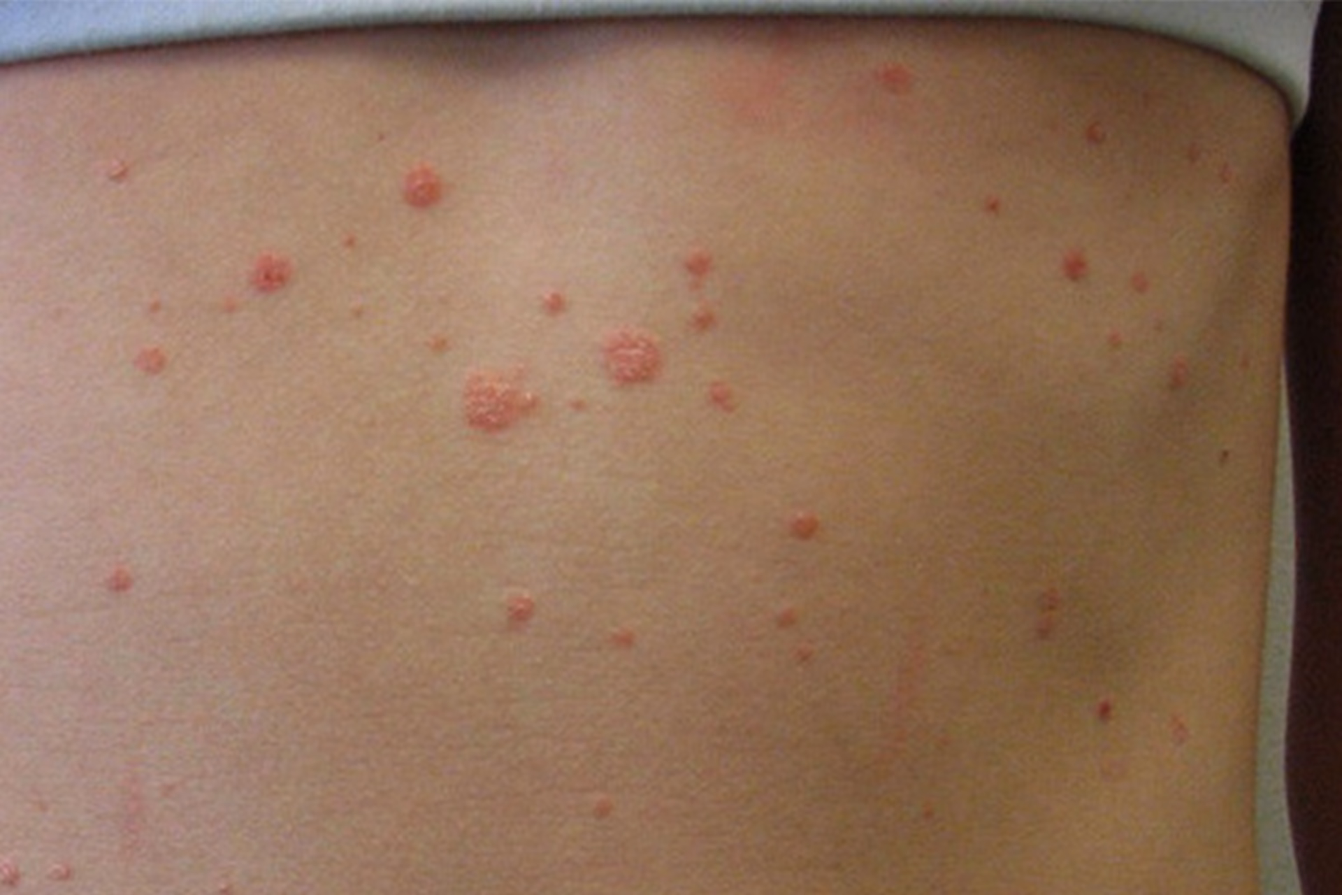 How is guttate psoriasis managed?