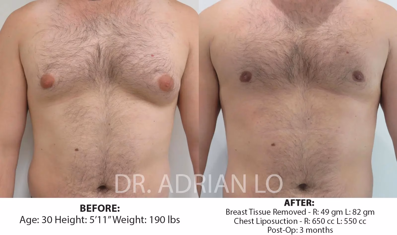 How much does gynecomastia surgery cost?