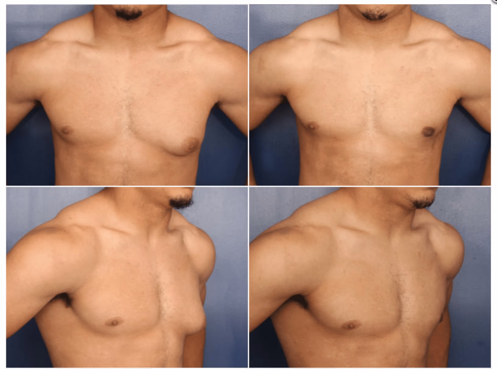 What is gynecomastia surgery?
