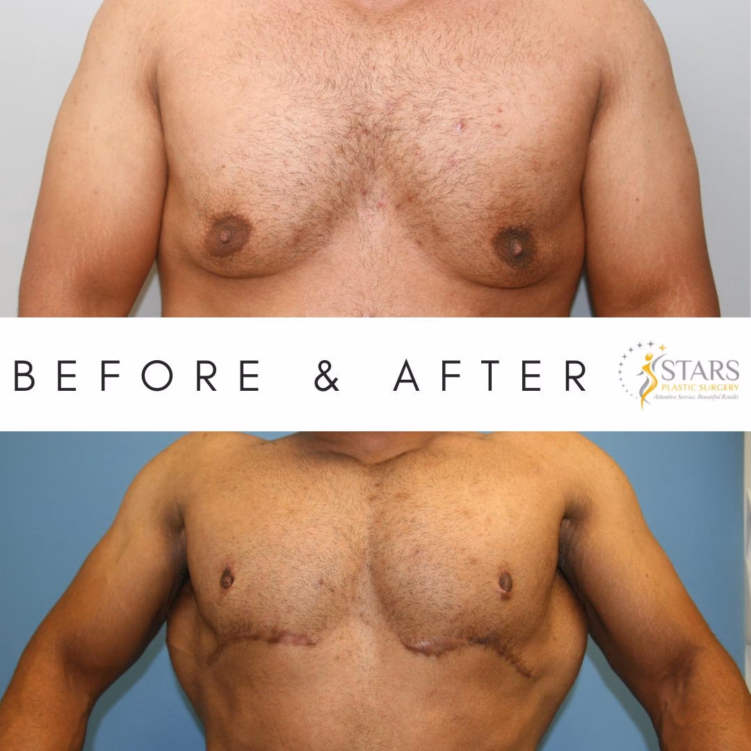 How many gynecomastia surgery questions are there?