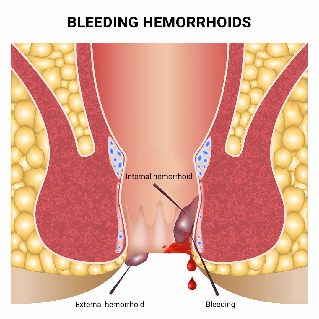 How do I choose a hemorrhoid cream?