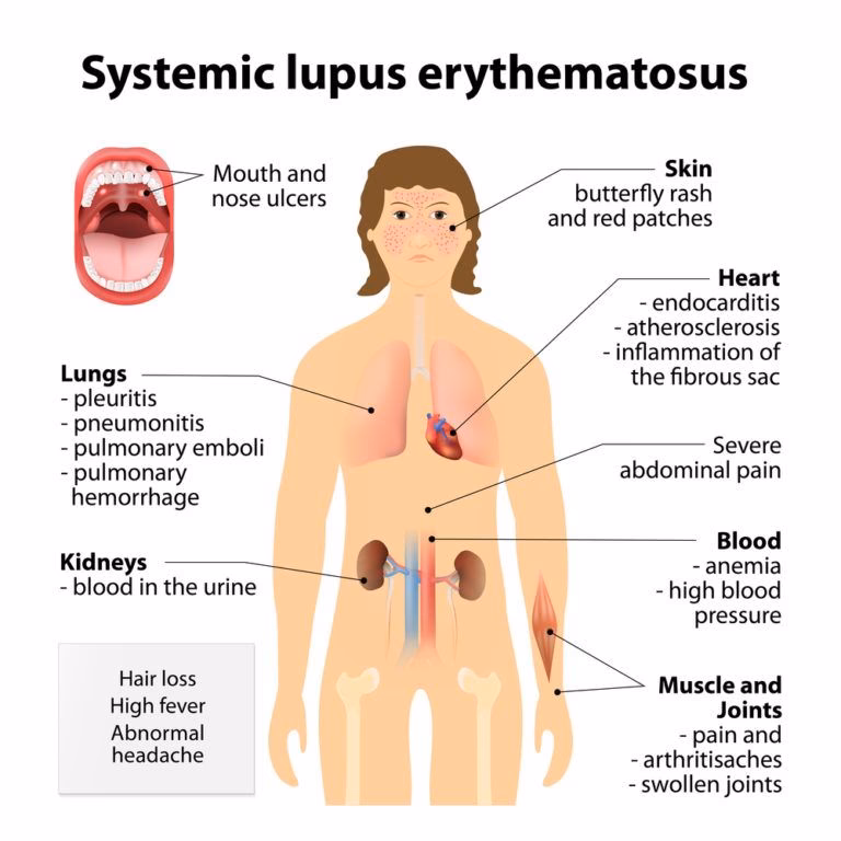 What is the code for systemic lupus erythematosus (SLE)?