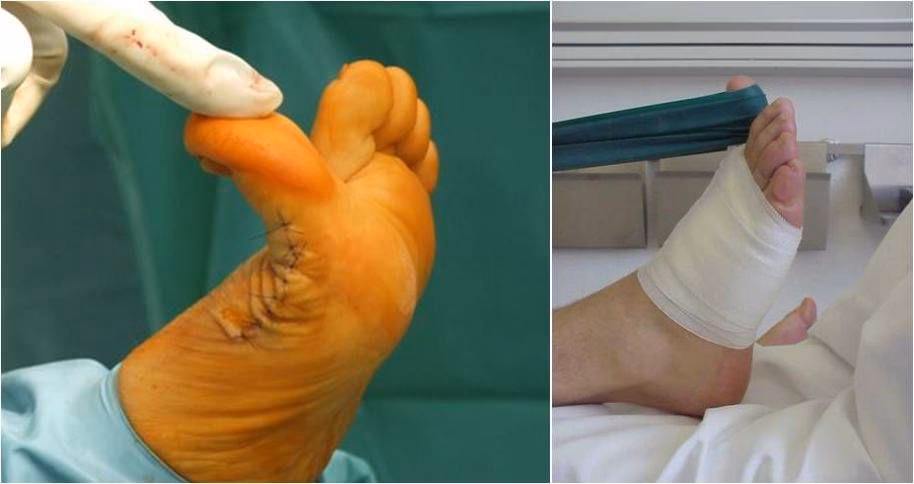 Welche Arten von Hallux-OP gibt es?