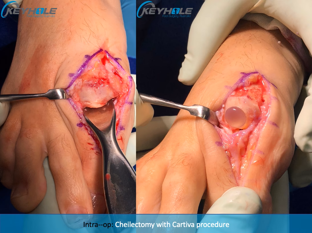 Can A cheilectomy be done with a hallux rigidus?