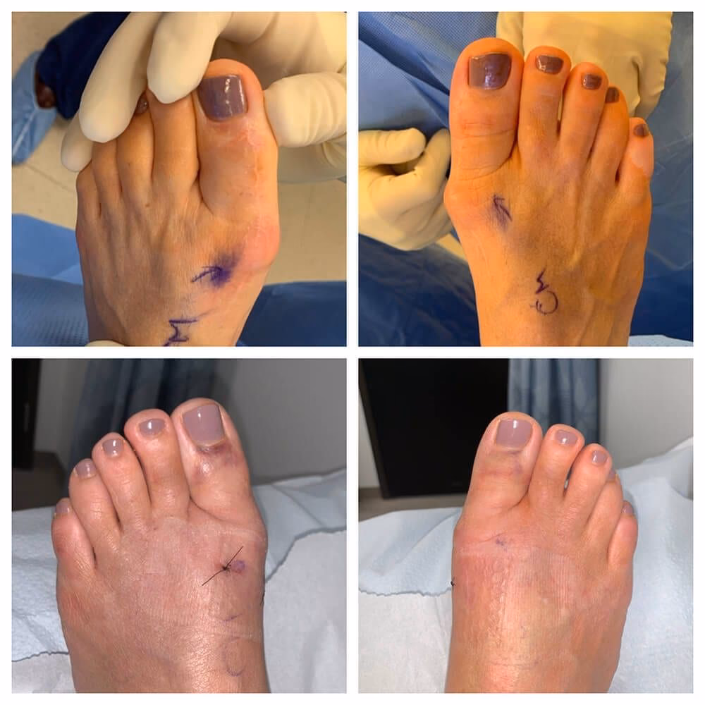 Can steroid injections help with hallux rigidus?
