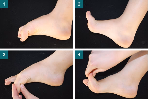How long does it take to recover from hallux rigidus surgery?
