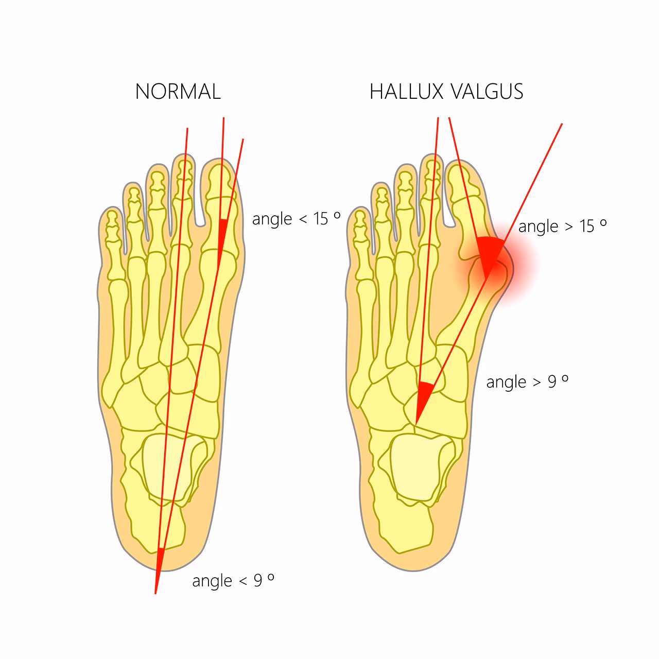 Wie viele Frauen leiden unter Hallux valgus?