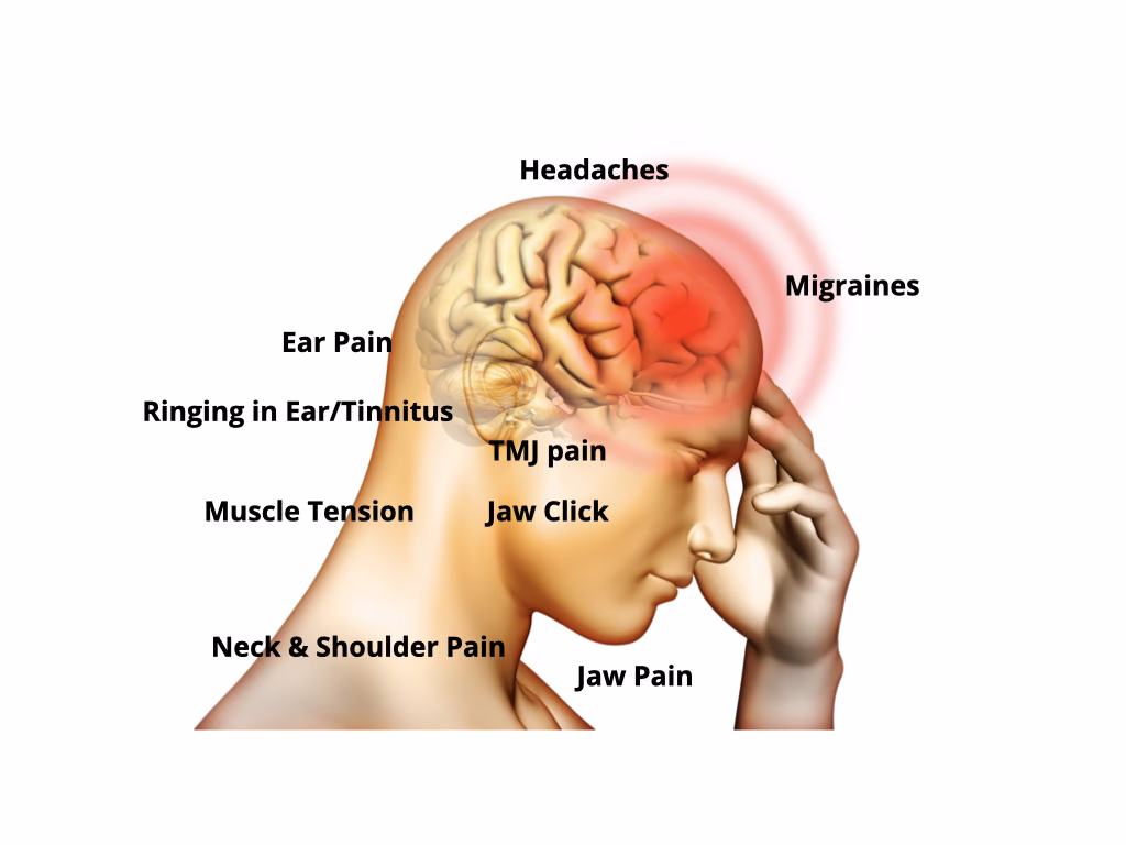 Can jaw clenching cause a migraine?
