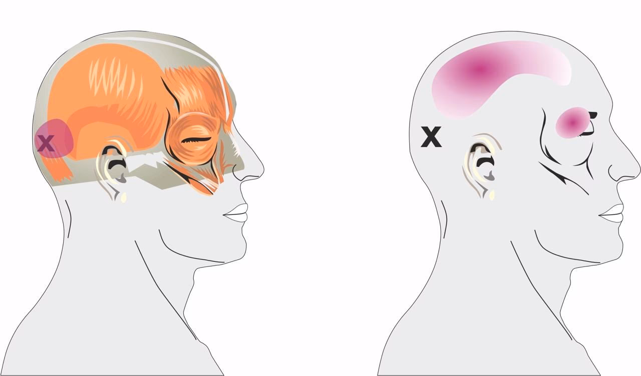 What does a headache on the top of your head mean?