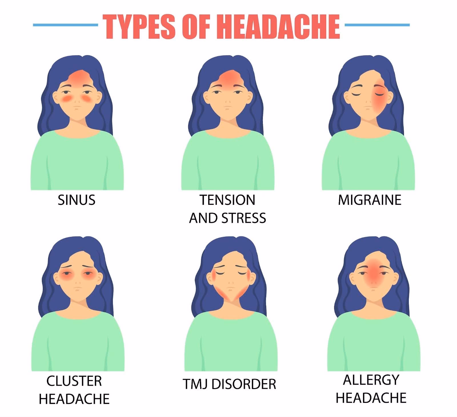 What is a migraine headache?