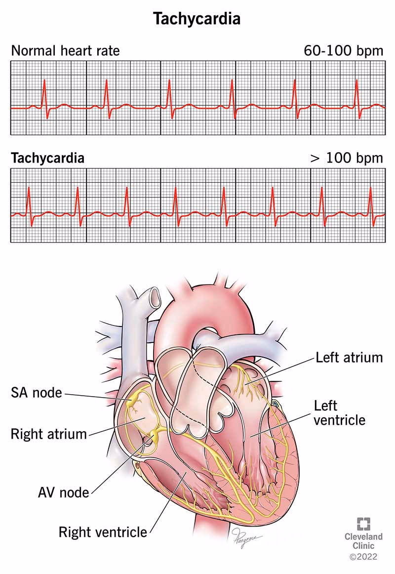 What does a 120 resting heart rate mean?