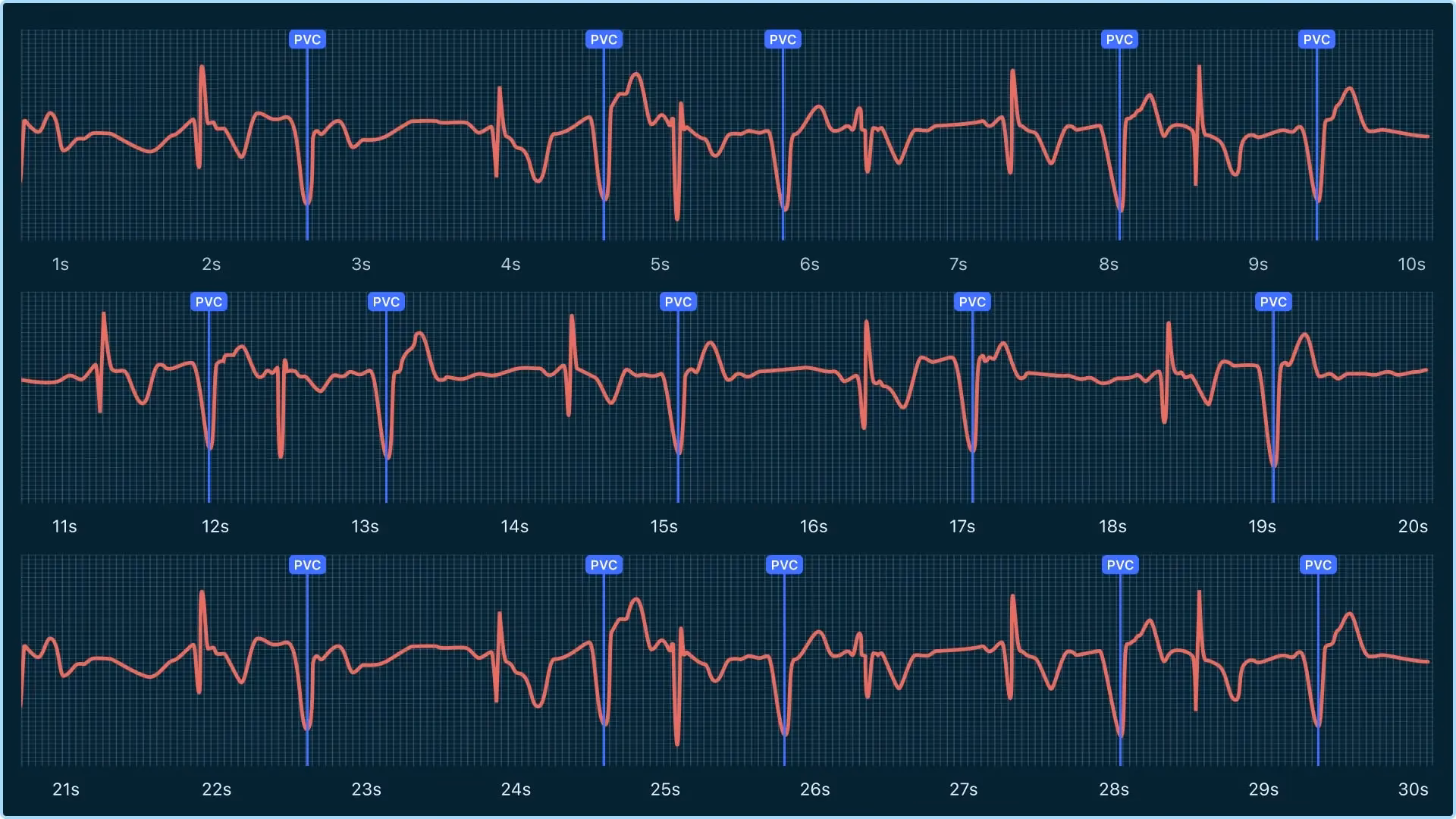 How do you know if a heart attack is causing palpitations?