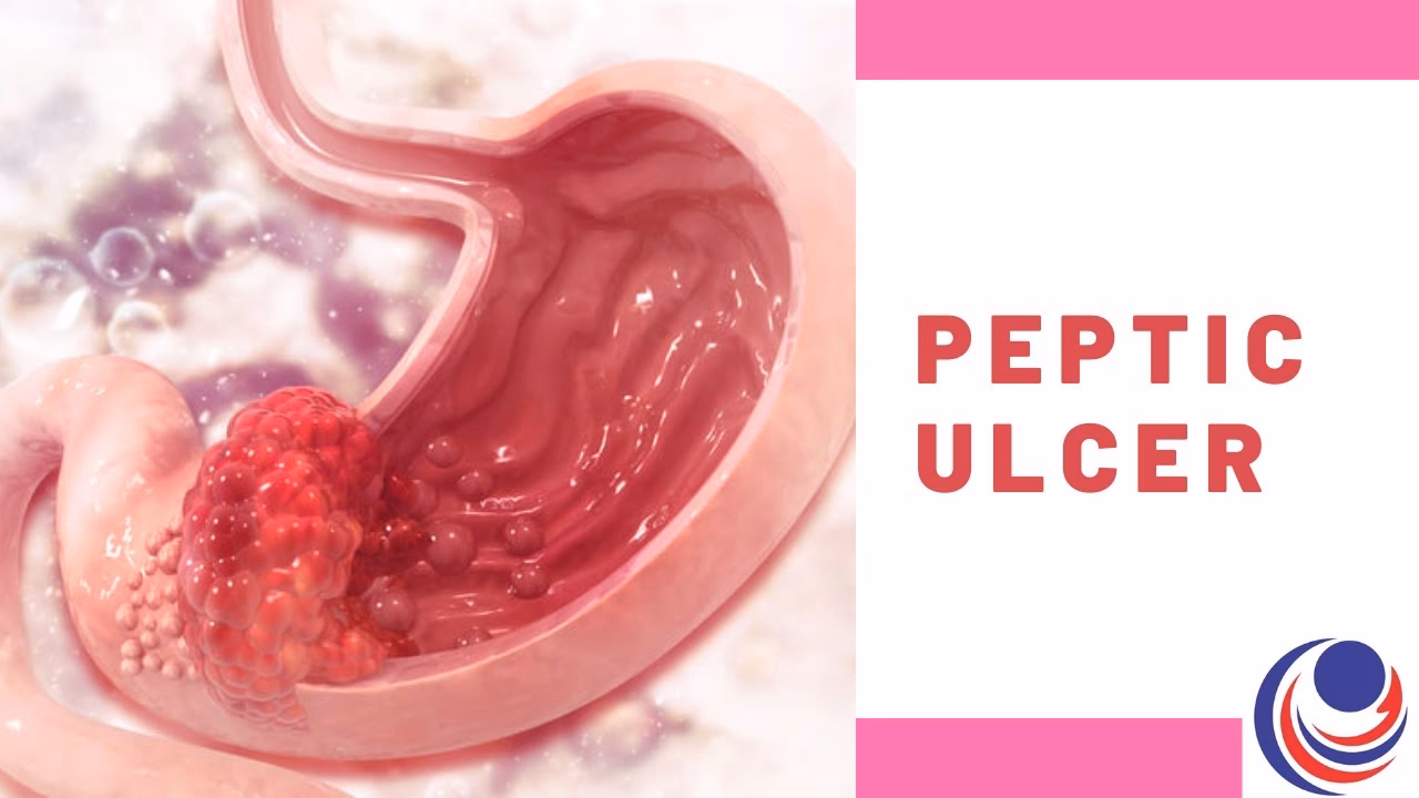 Can Gerd/ulcer cause heart palpitations and a burning sensation?