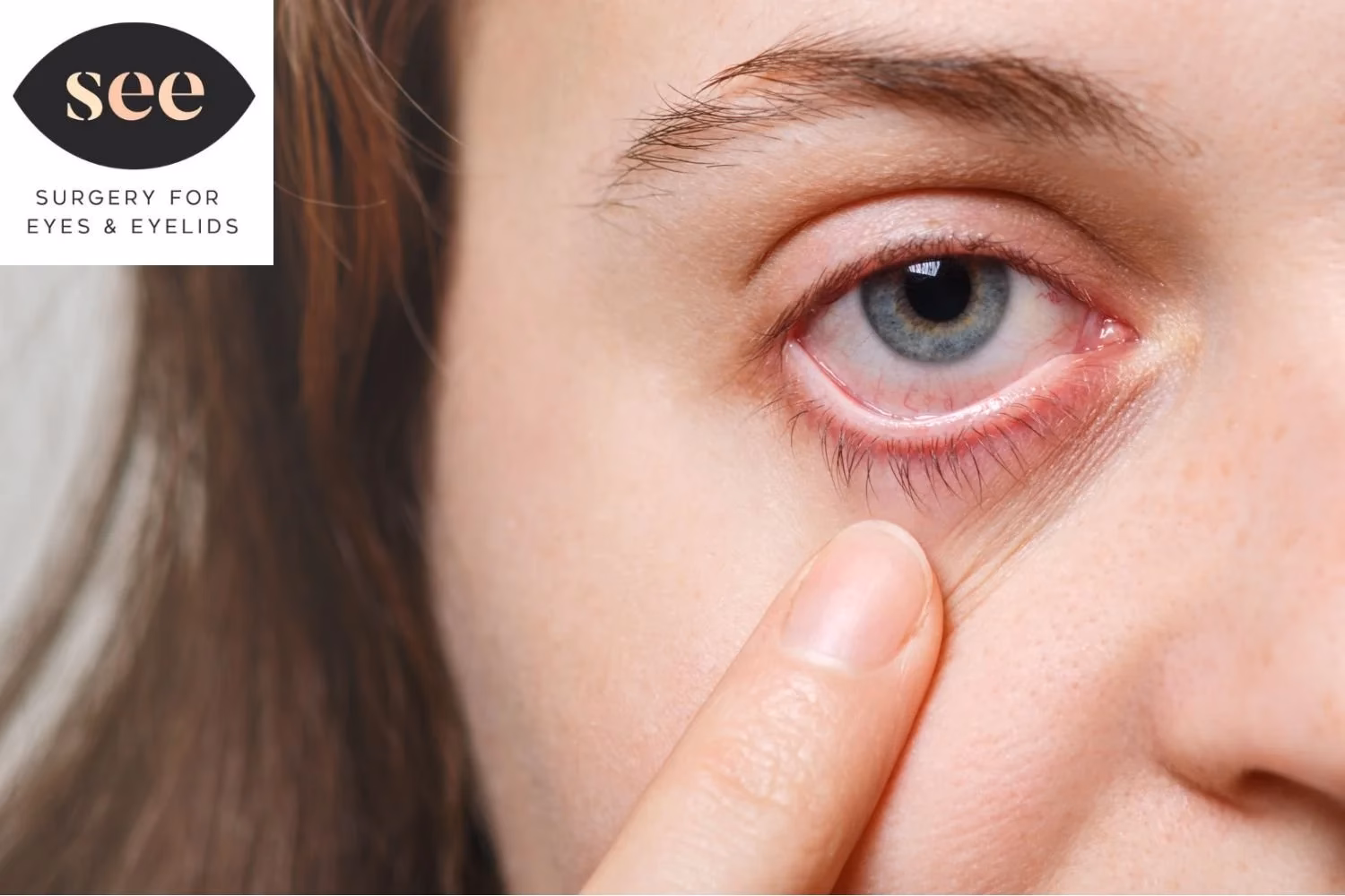 Can dry eye make your eyelids feel heavy?