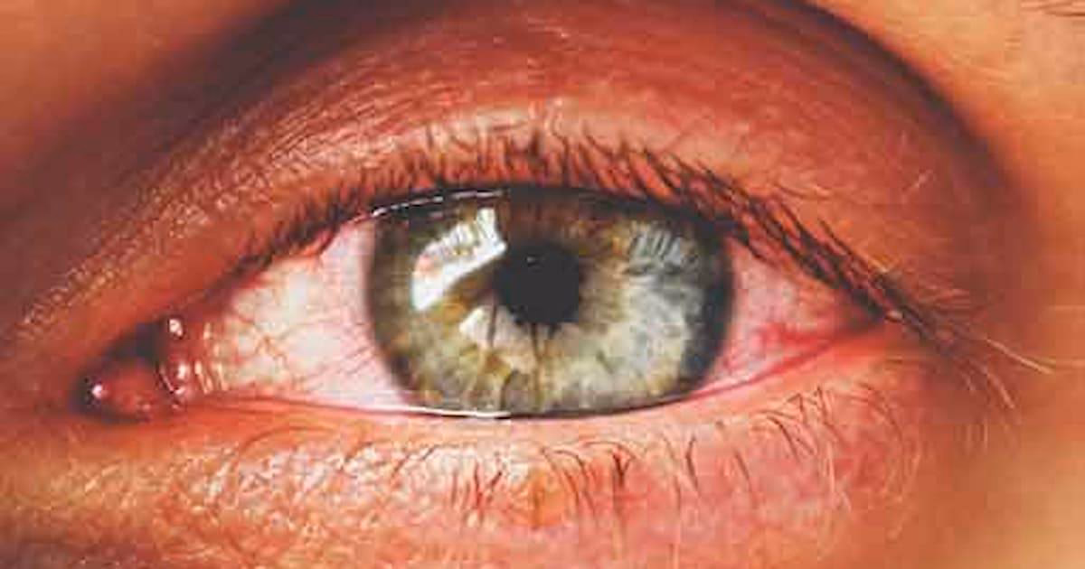 What are the symptoms of eye allergies?
