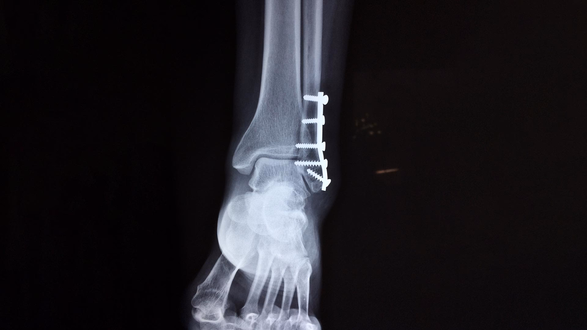 Wie behandelt man einen Bruch?