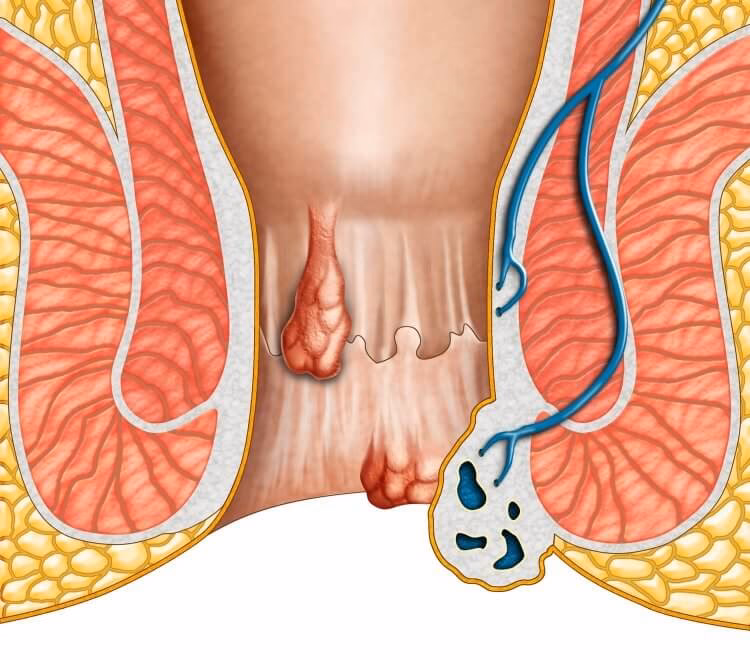 Are hemorrhoids safe during pregnancy?