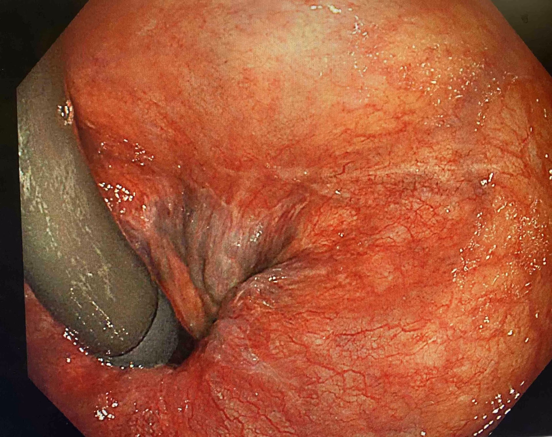 How do you know if you have a hemorrhoid?