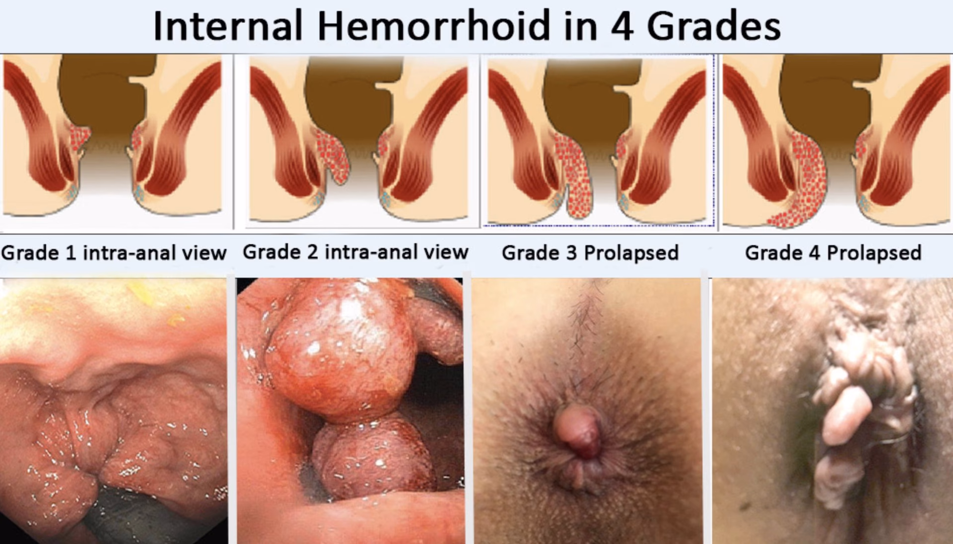 What is the ICD 10 code for thrombosed external hemorrhoids?
