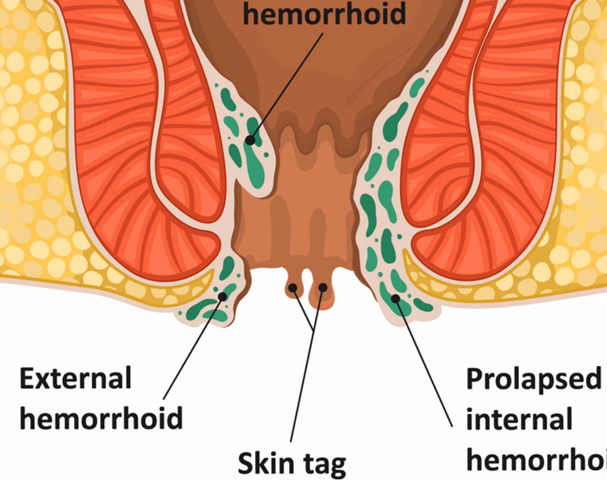 Why do hemorrhoidal anal skin tags get bigger than a fingernail?