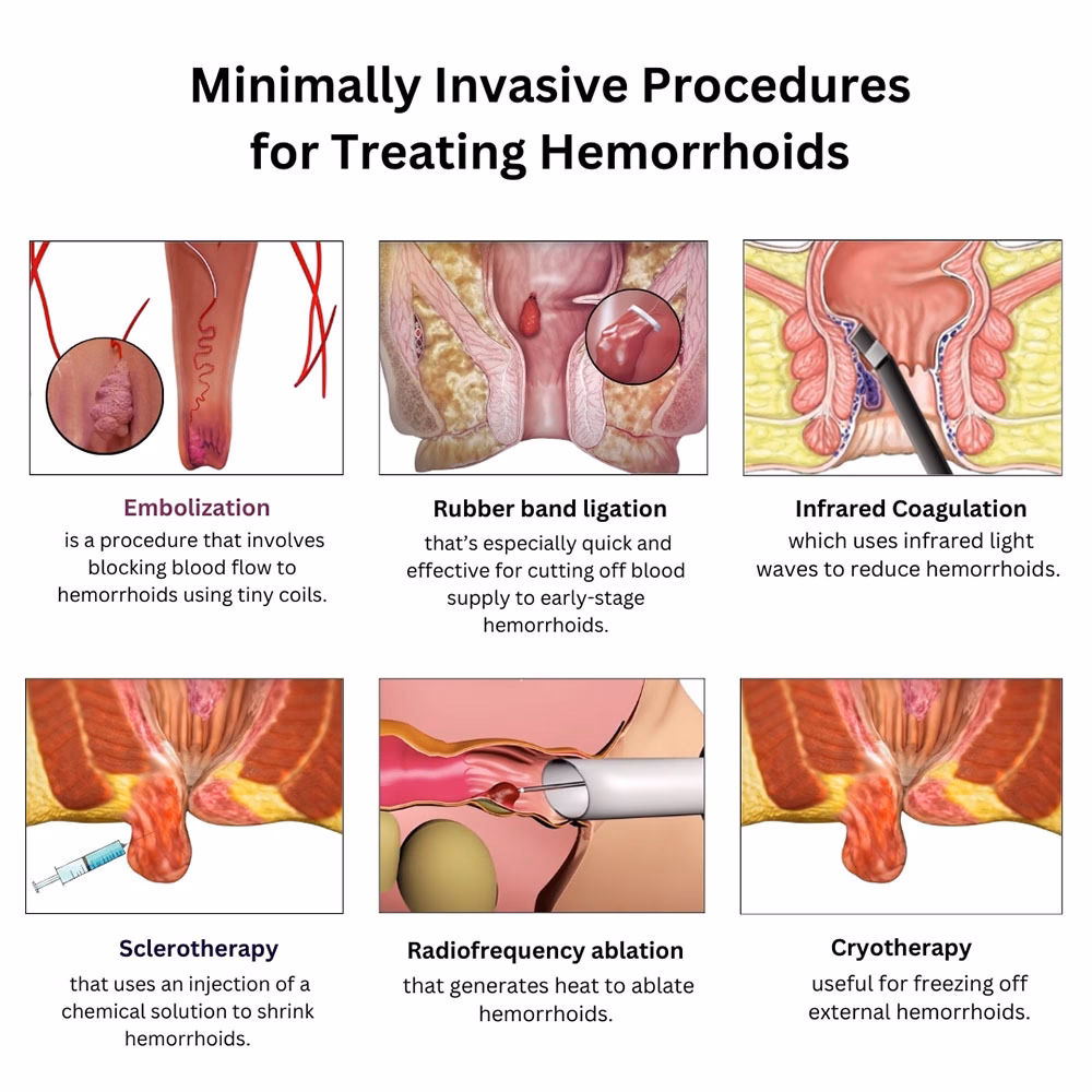What are hemorrhoids & how are they treated?