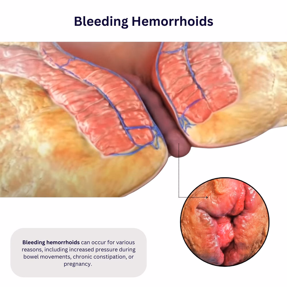Do hemorrhoids cause pain?