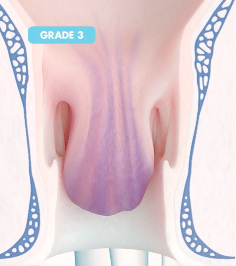Does a prolapsed hemorrhoid protrude from the rectum?