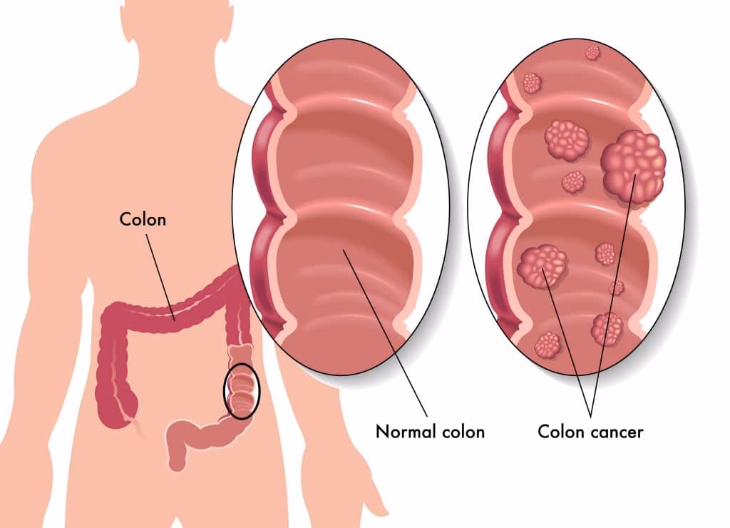 Do colorectal cancer symptoms overlap with hemorrhoid symptoms?