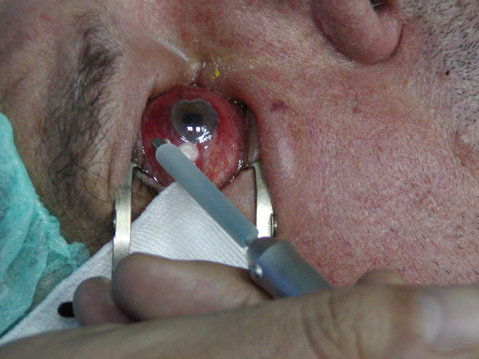 How does hemorrhoidopexy work?